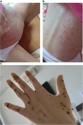Case Report: Taking action or standing by: managing a preterm neonate at the risk of neonatal varicella by metagenomic next-generation sequencing